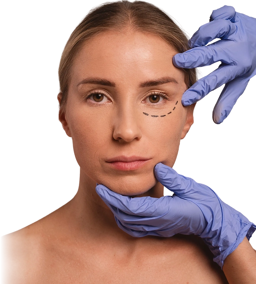 Paciente com marcação na região dos olhos durante avaliação para blefaroplastia