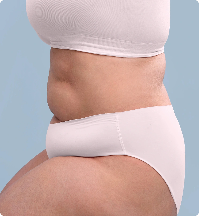 Side view of a patient’s abdomen during an evaluation for fat harvesting