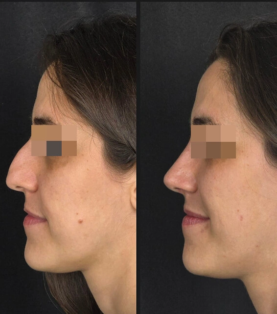 Rhinoplasty result — patient 1, profile before and after