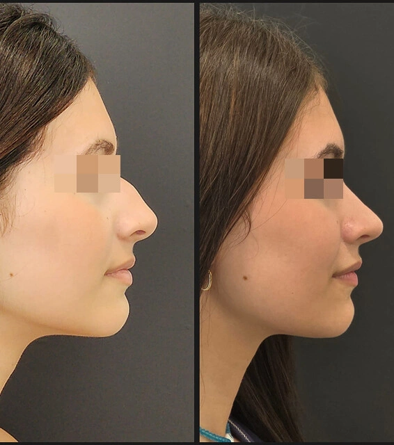 Rhinoplasty result — patient 2, profile before and after