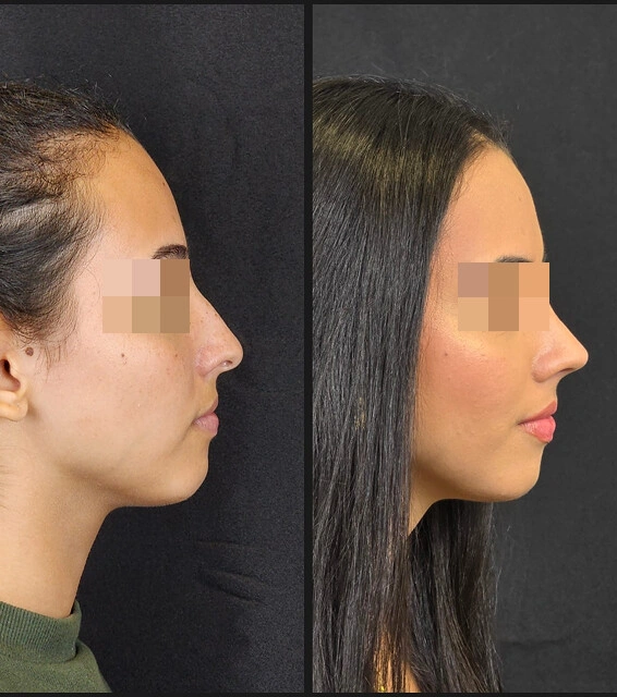 Rhinoplasty result — patient 3, profile before and after