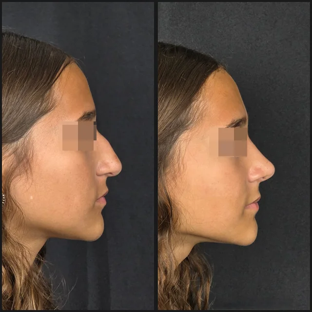 Rhinoplasty result — patient 4, profile before and after