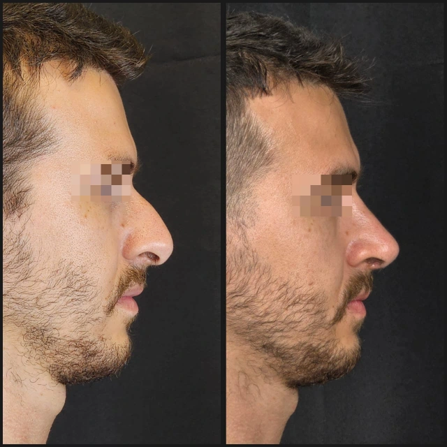 Rhinoplasty result — patient 5, profile before and after