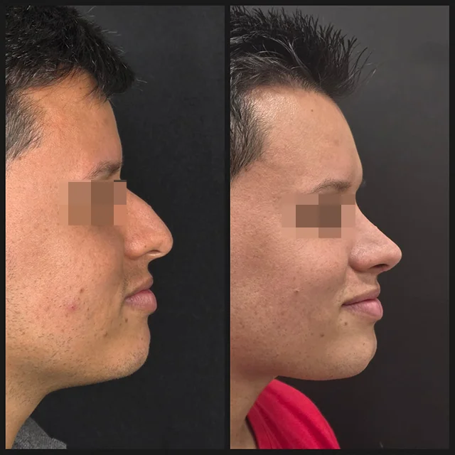 Rhinoplasty result — patient 6, profile before and after